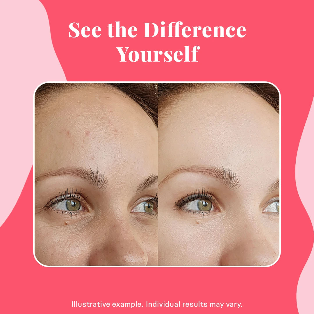 Visible skin improvement before and after using vegan collagen booster, showing reduced blemishes and smoother forehead texture.